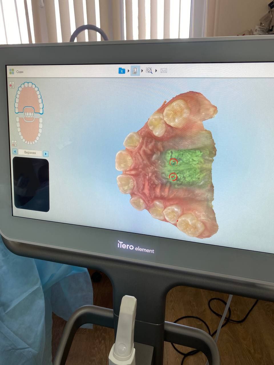 В клинике стоматологии  СГМУ с помощью 3d технологий первыми в регионе начали безоперационное лечение тяжёлых форм аномалий у детей